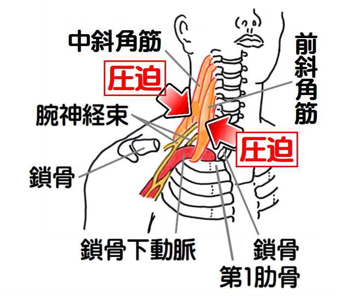 胸郭出口症候群　斜角筋症候群の図3