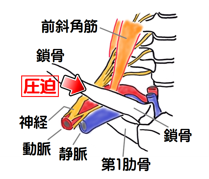 胸郭出口症候群　肋鎖症候群の図2