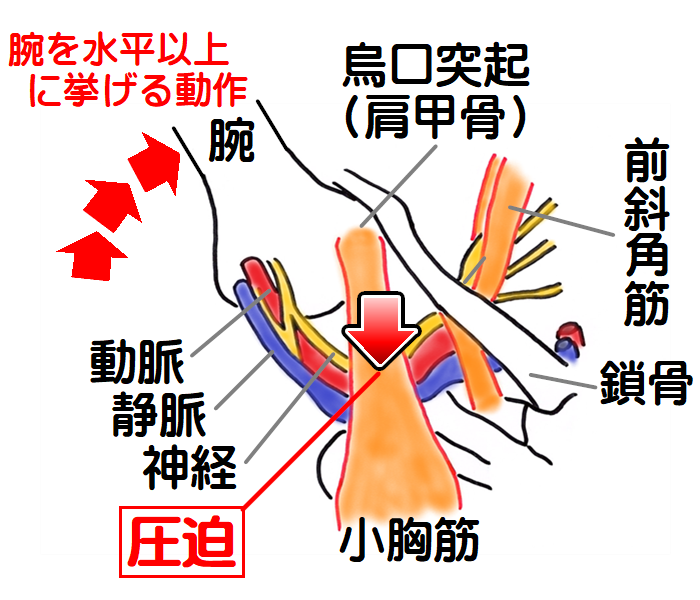 胸郭出口症候群　小胸筋症候群の図4