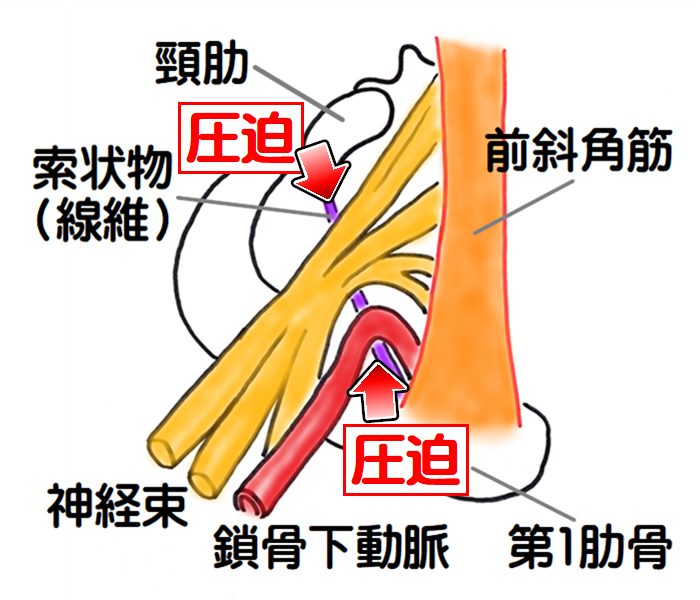 胸郭出口症候群　頸肋症候群の図3