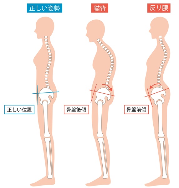 猫背と反り腰の図
